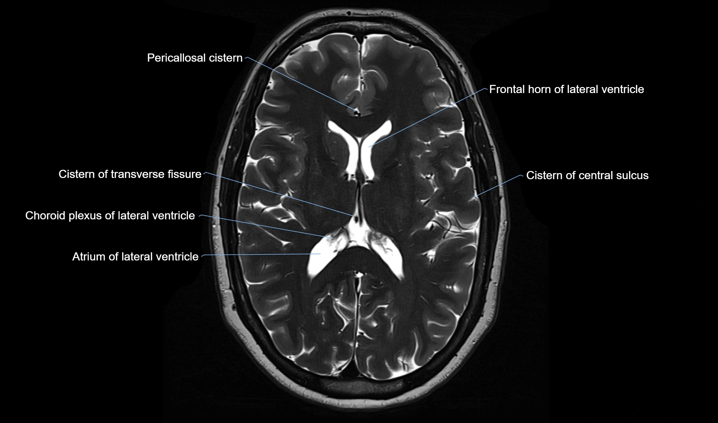Brain cisterns  and ventricles  axial anatomy 3T MRI image-img-00001-00032.webp